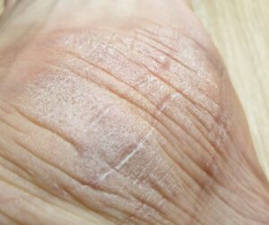 Úlceras en la piel en personas mayores -